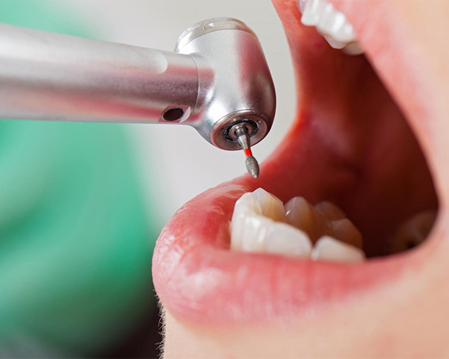 Image of endodontics service