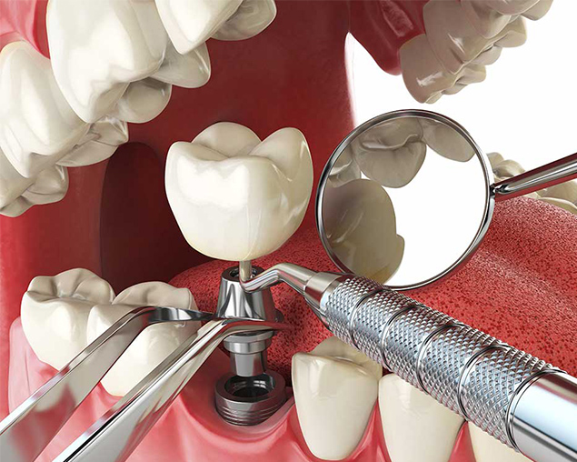 Image of implant dentistry service